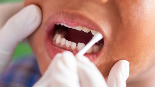 『虫歯にフッ素がなぜいいの？』虫歯予防に効果的な理由が知りたい！