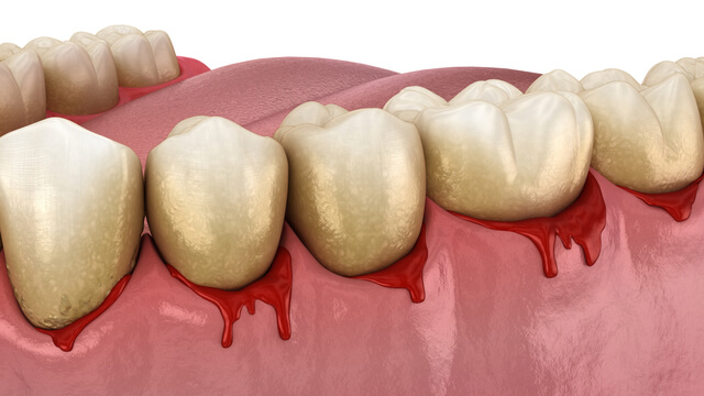 すぐに治療を！歯周病で最も重い症状の【歯槽膿漏（歯周炎）】の原因と予防法